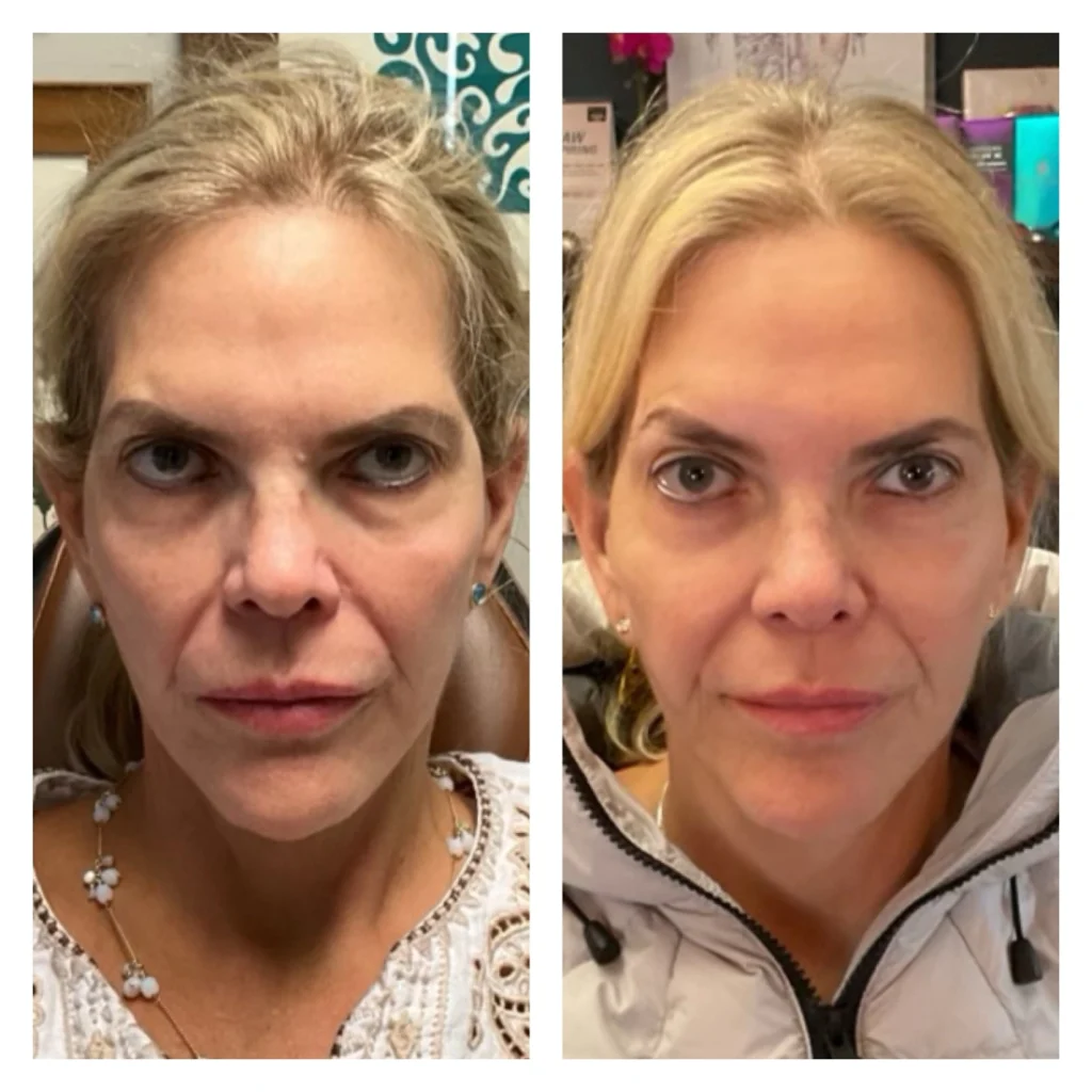 sculptra treatment